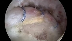 Femoral Head Chondral Defect in Professional Wrestler: Debridement vs. Osteoarticular Allograft