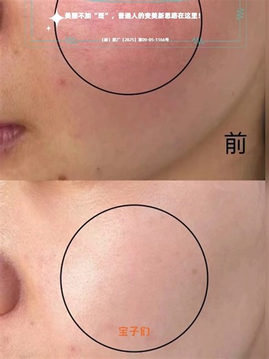 色斑困扰不断，美丽渐行渐远？别怕，祛斑方法来了！ #变美小技巧 #新疆变美小技巧 #新疆皮肤年轻化攻略 #新疆祛斑哪里好 #新疆看黄褐斑 乌鲁木齐美容