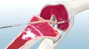 Soft Tissue ACL Reconstruction Using the Infinity™ Knee System