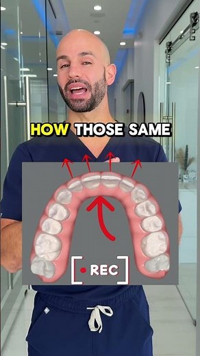 Correcting a deep bite because of extruded upper front teeth with Invisalign treatment.