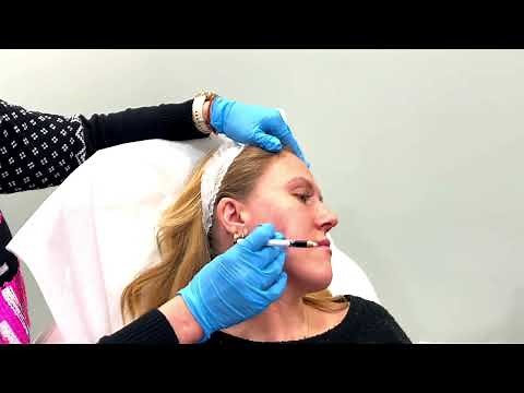 Volux Filler for Jawline - Full Treatment and Before and After Photos