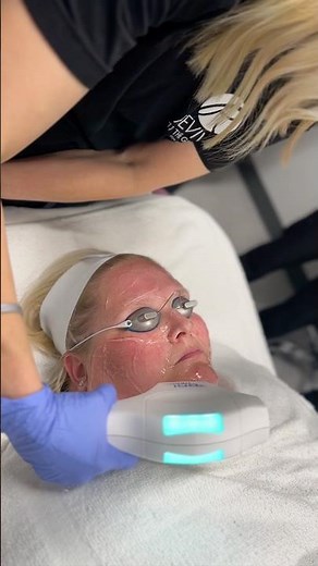 🎥 Watch as we perform this dual-targeted treatment using BBL HEROic!