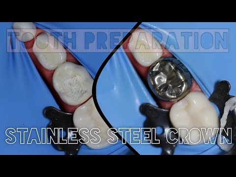 Tooth Preparation for Stainless Steel Crown | stainless steel crown procedure steps | ssc
