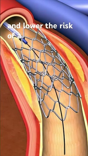 How Angioplasty Is Performed (3D Animation) #medical3danimation #3dmedicalanimation #angioplasty