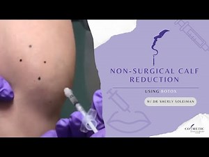 NON-Surgical Calf Reduction Using Botox by Dr. Sherly Soleiman