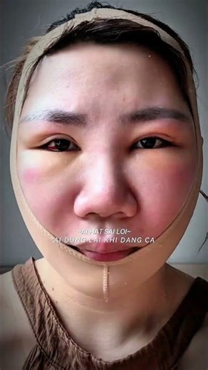 #CheekboneReduction for clients with high and protruding cheekbones #drdoanlam #girls #plasticsur...