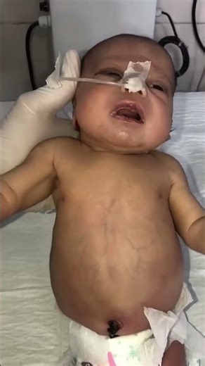 Abdominal Obstruction in Newborn | NG Tube Decompression | Shifted to Operation Theatre #cute