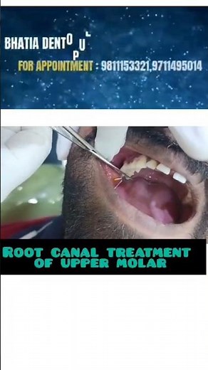 Painless Root Canal Treatment of Upper Molar Tooth #painlessdentistry #nopain #teeth