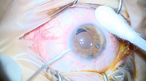 Ali Olgun Associate Professor.FICO,FEBO,MRCSEd on Instagram: "This patient was referred from an outside clinic for scleral IOL fixation due to aphakia after traumatic cataract surgery. IOL implantation was performed using the Yamane IOL fixation technique. Her vision without glasses increased from 1 mcf to 0.7 snellen, but as the photophobia complaints continued, it was decided to perform a pupilloplasty operation. In this video, you see 3 4 throw pupilloplasty surgeries using PC9 suture. What d