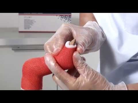 Delta-Cast Soft Club Foot Cast Application
