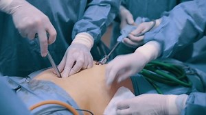 Video endoscopic surgery. The surgeon inserts an endoscope into the patient's abdominal cavity. Removal of the gallbladder in the clinic.