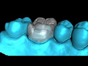Crown Design and Fabrication Using the FREE Blue Sky Bio Crown and Bridge Module
