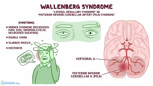Wallenberg Syndrome: What Is It, Causes, Diagnosis, Treatment | Osmosis
