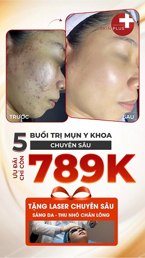 TRỊ MỤN DỨT ĐIỂM MÀ VẪN TIẾT KIỆM? Bạn đang đau đầu vì mụn viêm, thâm sẹo, lỗ chân lông to? Skin Plus mang đến giải pháp đột phá với ưu đãi có 1-0-2! 🔥 TRỊ MỤN CHUẨN Y KHOA 5 BUỔI CHỈ 789K 🔥 ✔️ Mụn được xử lý tận gốc, không lo tái phát. ✔️ Vết thâm mờ đi, da mịn màng, đều màu hơn. ✔️ Lỗ chân lông được se khít, da căng bóng. 🎁 ĐẶC BIỆT NHẤT: Tặng kèm liệu trình Laser Pico Sure sáng da, mờ thâm hiệu quả. Đừng bỏ lỡ cơ hội “vàng” để lột xác làn da của bạn. Đăng ký ngay hôm nay! —----------------