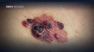 Experte erklärt: So schützt man sich vor Hautkrebs