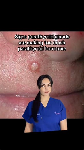 Hyperparathyroidism is excessive parathyroid hormone production, causing high calcium levels, leading to bone pain, kidney stones, fatigue, brittle hair, dry skin, itching, and calcium deposi | Dr. Mehss