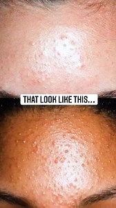 44K views · 201 reactions | Little Bump aka Fungal Acne 掠 | Skin Care By Hyram | Facebook