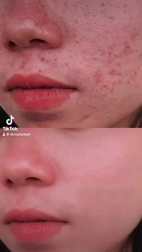 Unleash your inner confidence with Skin Place Laser Acne Treatment! Say goodbye to bothersome blemishes and hello to radiant, clear skin. Our state-of-the-art treatment doesn't just combat existing acne, it also prevents future breakouts, giving you the flawless complexion you've always desired. It's more than just skin deep, it's about embracing the best version of you. Get ready to glow! #skinplaceph #skincare #beautyph #laser #acne #acnetreatment #laseracnetreatment | Skin Place | Facebook