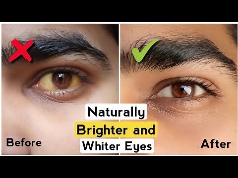 4 Tips to Get Brighter & Whiter Eyes |Get Rid of Yellow Eyes |White Eyes |How to have Attractive eye