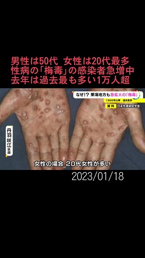 #性感染症 の「#梅毒 」、去年は全国で初めて1万人を超えるなど急増していて、東海3県でも過去最多を更新しています。その背景とは…。#名古屋 #中区 #池田公園 #街角保健室 #ニュースONE #TikTokでニュース #1月18日