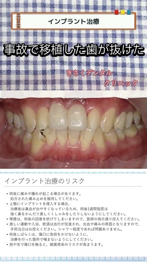 インプラント ビフォーアフター 事故で移植した歯が抜けた 【Before & After】 #きさくデンタル #インプラント #歯医者
