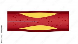 Angioplasty step by step animation 4K with white background. Medical education concepts related to heart health Stock Video