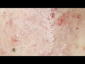 How to pop acne,blackheads,cyst under skin at hien van spa|434|Ngọc Thúy