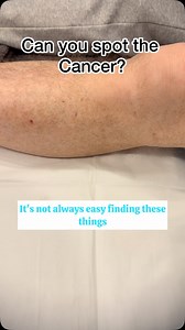 Here’s yet another basal cell cancer. They aren’t always obvious and the reality is unless you magnify them it can be easy to miss. Before putting the dermatoscope on I’d have been hard pressed to pick that cancer from the sea of red dots on this blokes legs but that’s why you magnify!! A subtle one today but a cancer nonetheless and picking it early means he gets a less aggressive treatment than if we’d picked it a year or two from now #skindoctor #skincancer #basalcellcarcinoma #pascoevale #br