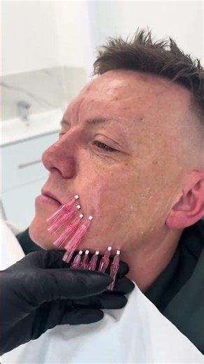 ✨ Diaminy PDO Mono Thread 29G – Anti-Wrinkle Solution ✨