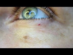 Plasma Pen - Fibroblast - Pigment & Angioma Removal