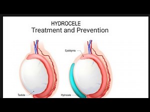 HYDROCELE (Treatment & Nursing Management) ||
