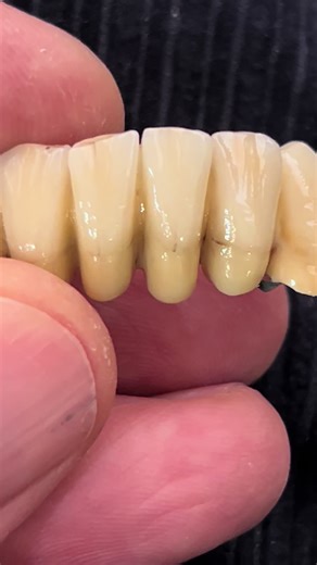 Fatto a mano con ceramica Diva Nobilmetal🇮🇹🦷🇮🇹🦷🇮🇹🦷🇮🇹🦷🇮🇹🦷🇮🇹🦷🇮🇹🦷 #dental #dentalcare #dentaltok #dentaltechnician #dentalesthetics