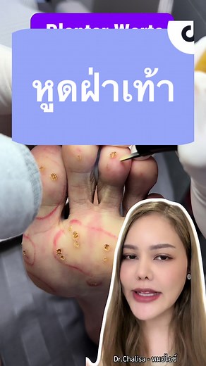 ตอบกลับ @A_PS❤️‍🔥 หูดฝ่าเท้า #หมอไอซ์ชาลิสา #chalisaice #พิษณุโลก #รีวิวบิวตี้ #TikTokกินเที่ยว #คนไทยรู้ทัน #warts #hpv #รีวิวbotox #รีวิวfiller #botox #filler #รีวิวคลินิก #รีวิวเลเซอร์ #รีวิวฟิลเลอร์ #ฟิลเลอร์คาง #ฟิลเลอร์ใต้ตา #longervideos #รีวิวบิวตี้ในtiktok #ฟิลเลอร์หน้าผาก #subcision #หลุมสิว #ฟิลเลอร์ปาก #TikTokLooks #tiktokuni #รักษาแผลเป็น #keloid #keloidremoval #รักษาคีลอยด์ #ลบรอยสัก @CHALISA ICE - ชาลิสา ไอซ์ @CHALISA ICE - ชาลิสา ไอซ์ @CHALISA ICE - ชาลิสา ไอซ์