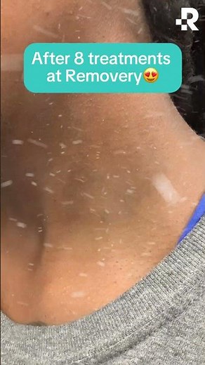 Tattoo Removal Results🔥 #removery