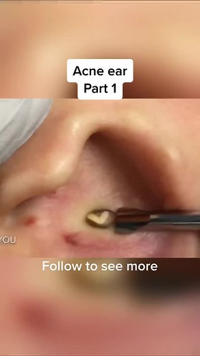 Whiteheads inside ear #acneshot #cyst #pimple #cystpopping