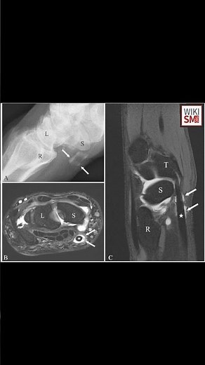 Flexor Carpi Radialis Explained 💪🦴#anatomy #meded #physiotherapy #ATC #ortho