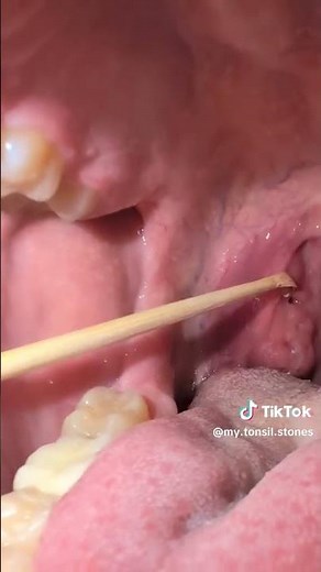Tonsil stone removal #2
