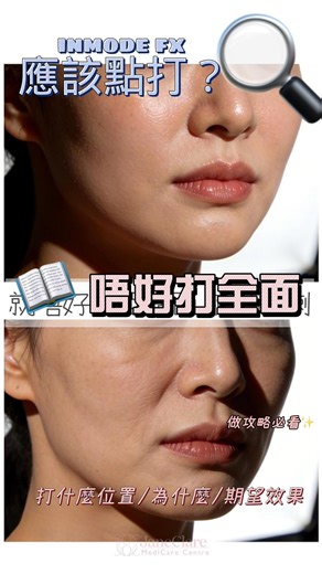InMode ｜Morpheus8 M8黃金微針 ｜治療中心｜持牌醫療中心｜JaneClare Medicare Centre on Instagram: "非侵入式的美容治療，廣泛應用於抗衰老、緊緻肌膚 使用先進的射頻技術，深入肌膚底層，刺激膠原蛋白的再生，從而改善細紋、皺紋和肌膚鬆弛的問題。 再使用註冊專利技術，爆破皮下脂肪細胞，從根源解決脂肪問題。 🔥精準打擊浮腫脂肪，重塑輪廓🔥 爆脂🔥滅絕脂肪細胞 絕！不！反！彈！ ❄️限定優惠至2026年2月28日， 療程需於3月30日前完成，限新客戶。 只需支付$100訂金留位，享受優惠。 體驗價只需$888 inmode fx 買一送一（即2次療程） ☏ 尖沙咀分店 𝕎𝕙𝕒𝕥𝕤𝔸𝕡𝕡：+𝟠𝟝𝟚 𝟡𝟚𝟚𝟘 𝟡𝟝𝟟𝟞 📍地址：尖沙咀金馬倫道18-20號萬勤商業大廈8樓A室 🕐營業時間：星期一至五 11:00-9:00，星期六 10:00-7:00。"