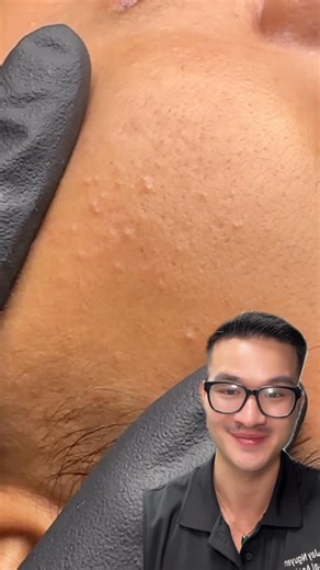Jay Nguyen • Acne Specialist 🇨🇦 🇻🇳 on Instagram: "Comedones 101 ⬇️ Comedones are clogged pores made of oil, dead skin cells, and debris. They’re the starting point of acne and how you treat them matters. ▫️ Open comedone (blackhead): the pore is open. The dark color is oxidation, not dirt. ▫️ Closed comedone (whitehead): the pore is sealed, forming small bumps under the skin and is more likely to turn inflamed if mistreated. How to treat them properly: ✔️ Gentle cleansing (don’t strip your s