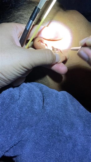 #ear #cleaning #asmr #earcleaning