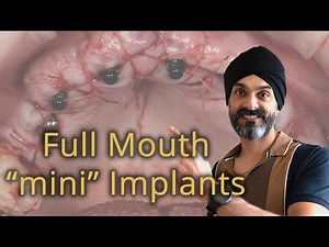 Full Set of Dental Implants, with Mini Implants, 1/2 the cost of All on 4