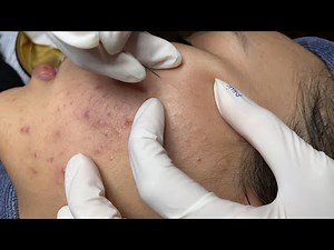 Blackheads Removal at Nhim Acne Da Nang #113