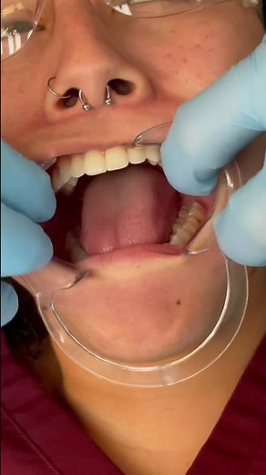 Real time check retractor insert 😬😳⏰