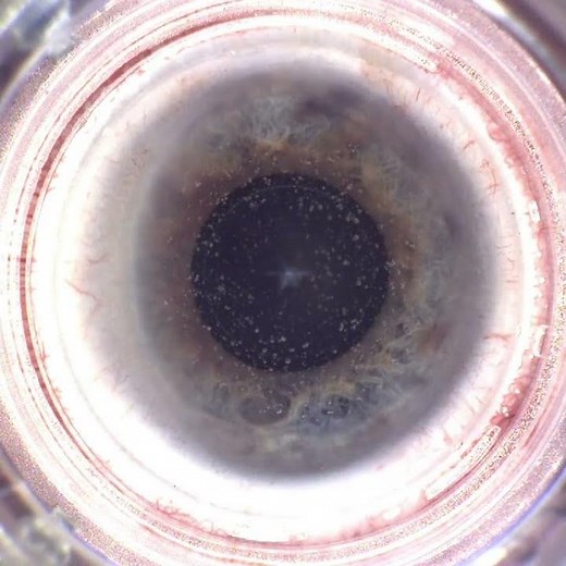 Laser Cataract Surgery
