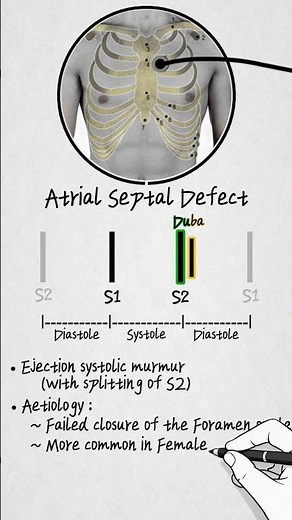 Heart Sound & Murmur (Atrial Septal Defect, Ventricular Septal Defect & Patent Ductus Arteriosus)