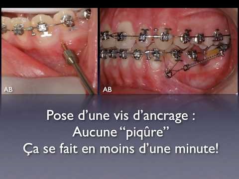 Mini-vis d'ancrage en orthodontie orthoLemay.com.mov