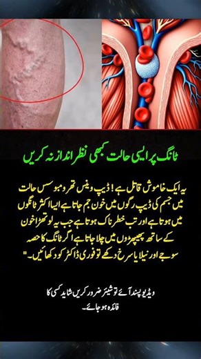 Silent Killer in Your Legs – Deep Vein Thrombosis Warning!