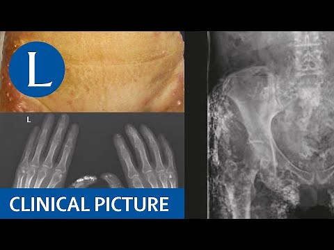 Soft tissue calcification in systemic sclerosis, polymyositis, and polyarthritis