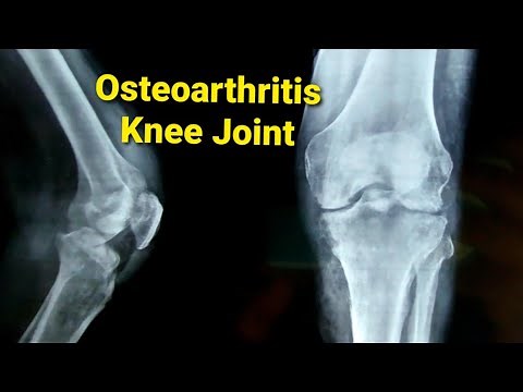 X-ray Findings in Osteoarthritis with Osteomyelitis of Knee Joint