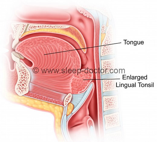 Lingual Tonsillectomy - Sleep Doctor
